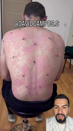 Psoriasis #drdavidcampos
