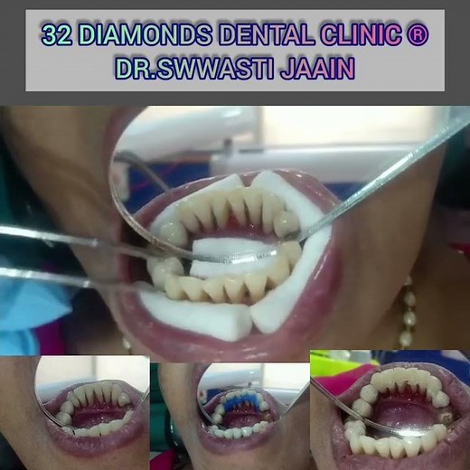 Mobile Teeth Treatment using fibre splints