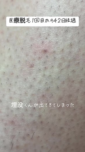 医療脱毛42日後の経過と埋没毛の影響