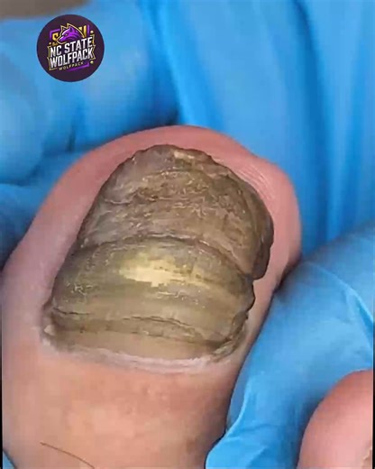 13K views · 112 reactions | Doctor-Approved Tips for Help Busy Adults Prevent Calluses and Cracks #FootCareTips #SimpleHealthTricks #EverydayCare #FootWellnessUSA | NC State Wolfpack on TheWolfpacker.com | Facebook