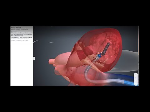 mCRM™ System: EMPOWER™ Leadless Pacemaker Retrieval Demonstration