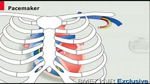pace makers