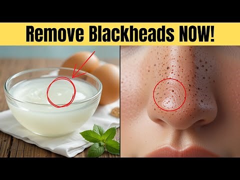 Naturally Remove BLACKHEADS at Home Without Any Tools!