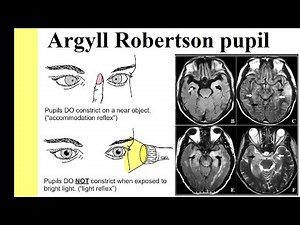Argyll Robertson pupil