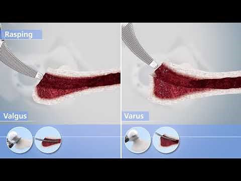 Mathys: Implantation of the calcar guided optimys stem
