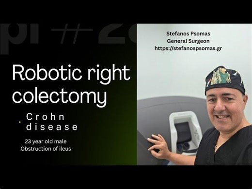 Robotic right hemicolectomy . Crohn disease. Intracorporeal anastomosis | St. Psomas General Surgeon | Stefanos Psomas