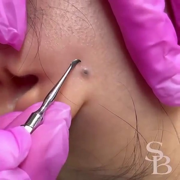 Skin Care Top News | The best blackhead extraction EVER Credit: @thedallasaesthetician #blackheads #oilyskin #whiteheads #acne #blackheadremoval #pimples... | Instagram