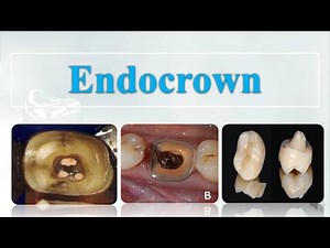 Endocrown | What is & How to make ?