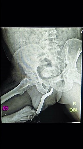 RGU PROCEDURE ( No obvious stricture /obstruction is seen )