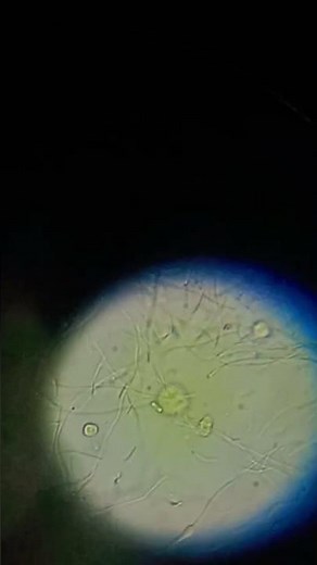 mucus threads in urine under microscope #urineinfection #urine #microscope #urinetest #shorts