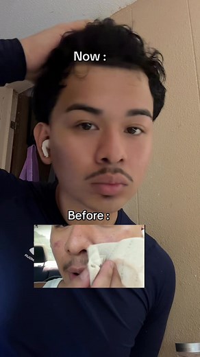 The Ordinary Acne Set: Confidence Restored