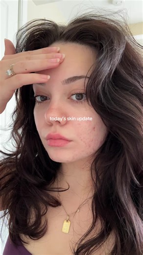 Calmer Days in My Acne Journey