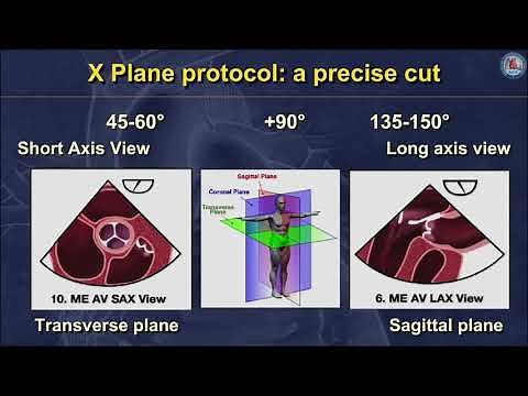 Echocardiographic assessment of aortic regurgitation—what should the surgeon know for AV repair?