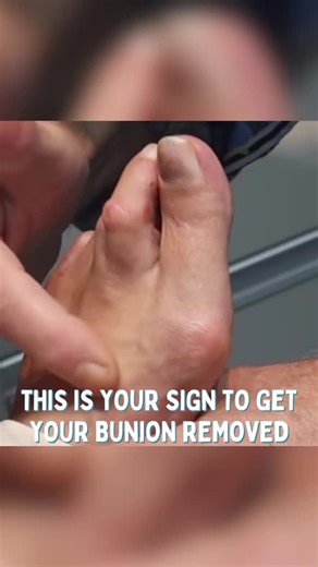 Bunion Correction Procedure: Walk Out Without Downtime
