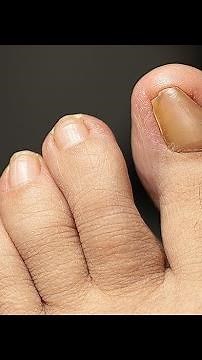 Ingrown toenail or onychocryptosis. What it is and how to treat it.