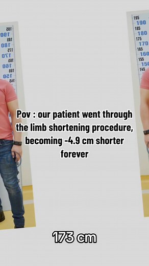 Before and after 🫱🏻‍🫲🏼🤜🏻🤛🏻 • • • #reduction #reductionsurgery #surgery #reductions #services #length #limbs #heigh #beatifull #heightsurgery #aestheticsurgery #short #clickthecapcut