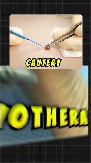 Plantar Warts Treatment Explained | Why Foot Pain Gets Worse After Removal? 🦶⚡️