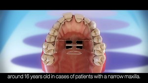 Orthodontic devices - Palatal expander and headgear | Dr.Tanveer's Dental Surgery