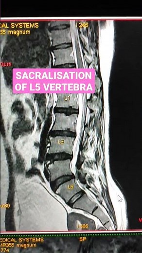 Sacralisation of L5 Vertebra #viral #mri #youtubeshorts #health