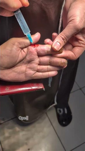 Gangrene Fingers Debridement vs Amputation Which Saves LIVES? #Gangrene