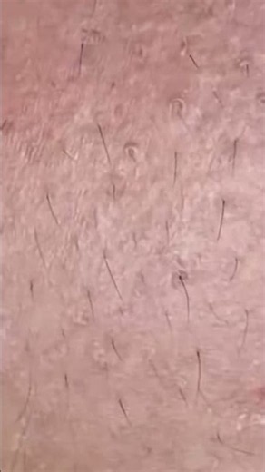 Big Cystic Acne Blackheads Extraction Blackheads & Milia, Whiteheads Removal Pimple Popping #shorts