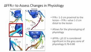 The importance of lesion-specific FFRCT values in the non-invasive assessment of coronary artery disease