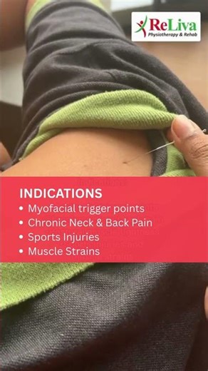 When to Use Dry Needling? Physiotherapy Benefits Explained #dryneedling