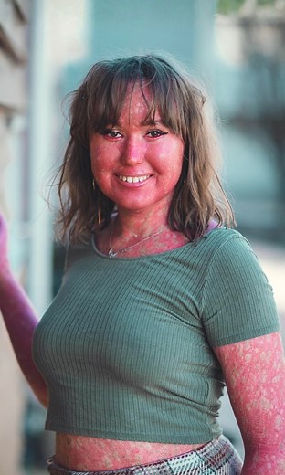 232K views · 3.9K reactions | My skin isn't 'contagious' - it's beautiful 懶 | Born Different | Facebook