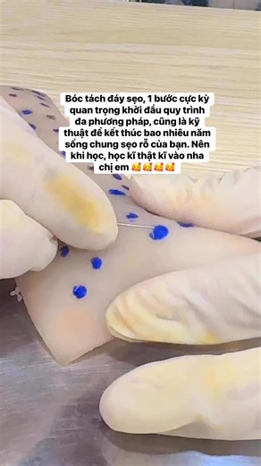 Bóc tách đáy sẹo, 1 bước cực kỳ quan trọng khởi đầu quy trình đa phương pháp, cũng là kỹ thuật để kết thúc bao nhiêu năm sống chung sẹo rỗ của bạn. Nên khi học, học kĩ thật kĩ vào nha chị em 🥰🥰🥰🥰 #boctachdayseo #sẹo #seoro #chuyengiaocongnghe | Thanh Trần