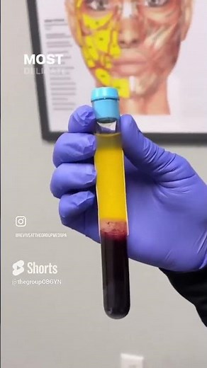 PRP under eye Injections