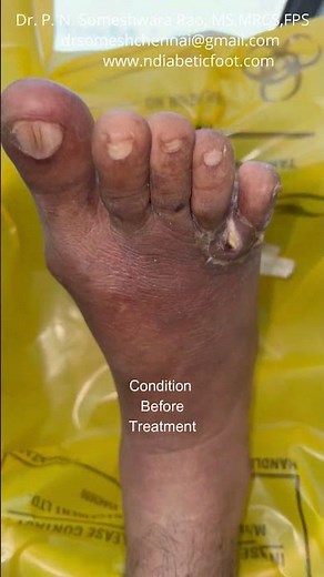 Athlete’s foot Before After #shorts