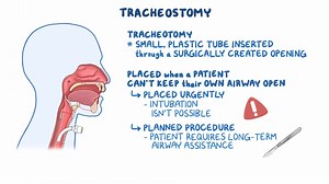Video: Tracheostomy - Video Explanation! | Osmosis | Osmosis