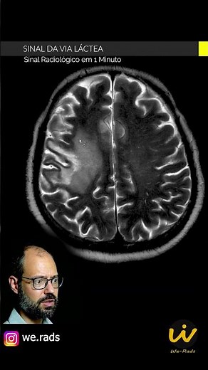 SINAL DA VIA LÁCTEA - LEUCOENCEFALOPATIA MULTIFOCAL PROGRESSIVA (LEMP)