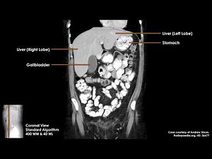 Liver & Gallbladder Anatomy on CT Scans