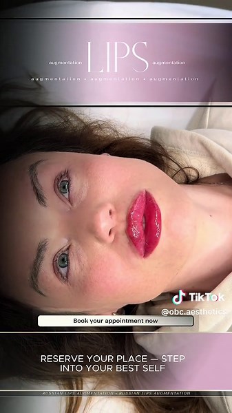 Russian Lips: The Ultimate Doll-like Transformation