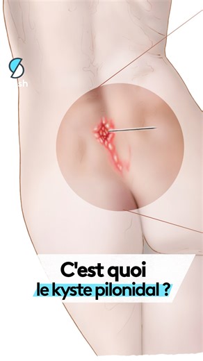 Slash on Instagram: "Le kyste pilonidal, tu connais ? 🍑⁠ C’est un petit problème de santé très courant… mais dont on parle peu.⁠ Dans cette vidéo, on t’explique ce que c’est, pourquoi ça arrive, les symptômes, et comment ça se soigne. (spoiler : oui, ça se traite, et non, ce n’est pas rare). ⁠ Tu en as déjà eu un ? Ou tu connais quelqu’un que ça concerne ?⁠ Raconte-nous en commentaire"