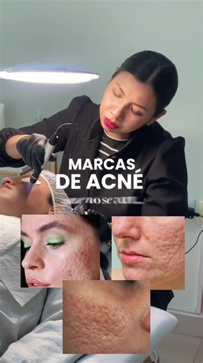 Dermapen: Tratamiento Efectivo para Secuelas de Acné