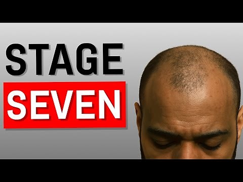 Do This EVERY Stage of Hair Loss (Complete Guide)