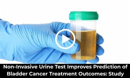 Non-Invasive Urine Test Improves Prediction of Bladder Cancer Treatment Outcomes: Study