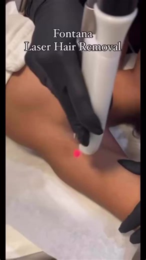 ✨ Smooth skin loading… Here’s a look at our Fotona Dynamis Pro Laser Hair Removal in action — fast, comfortable, and designed for long-lasting results. Best candidates: ✔️ All skin types (yes, even darker skin tones) ✔️ Anyone wanting to reduce unwanted hair ✔️ Perfect for legs, underarms, bikini, face more How it works: The Fotona system targets the hair follicle with precision, reducing hair growth with each session while keeping the skin safe and comfortable. How many sessions? Most clients n