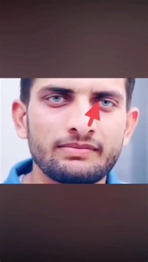 Rare Eye Condition #shorts #elchombo #eyeconditions