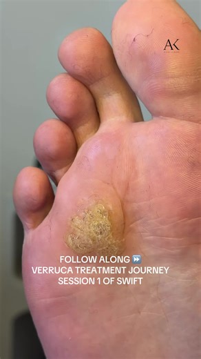 SWIFT® Verruca Treatment Journey: Session 1