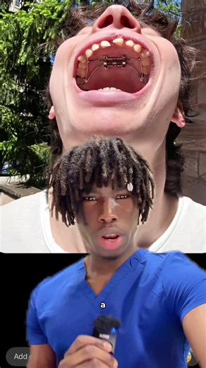 What If You Over Expand Your Palate #glowup #marpe #dental | narrow palate