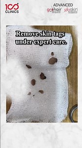 Skin Tag Removal – Smooth Skin, Quick & Safe Procedure ✨🌿