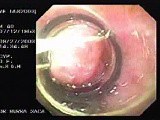 Acute Variceal Bleeding - Follow Up and Further Ligation of Varices • Video • MEDtube.net