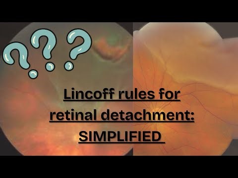 Lincoff rules for retinal detachment, Simplified !
