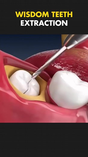 Wisdom Tooth Extraction: The Procedure Explained in 60 Seconds