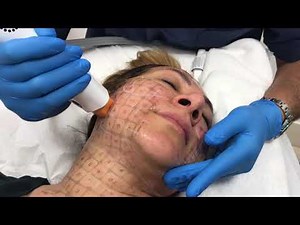 Thermage CPT for nonsurgical skin tightening