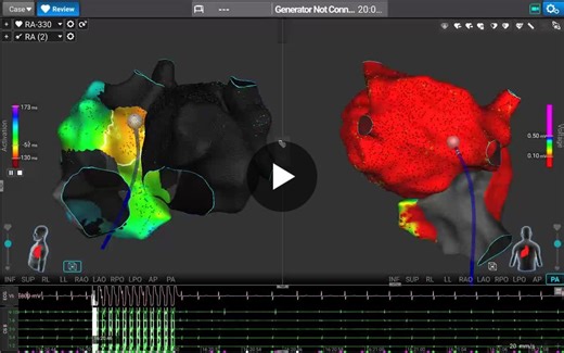#epeeps #atrialtachycardia #complexarrhythmia #affera #electrophysiology #ablation #coxmaze | Predrag Stojadinovic