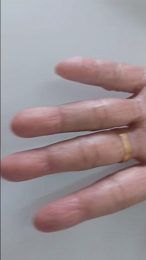 Tinea corporis Tinea manuum Onychomycosis